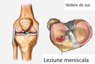 cum să tratezi un menisc în articulația genunchiului